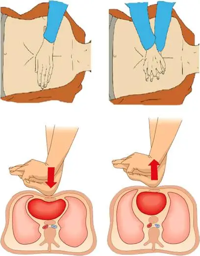 (2)按压手法:手掌根部放在胸部正中双乳头之间的胸骨上,另一只手平行